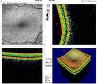 Трехмерная реконструкция макулярной области сетчатки глаза пациента 